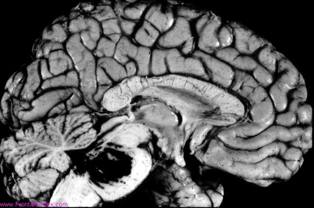 Hypertensive pontine hemorrhage, sagittal section